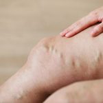varicose veins